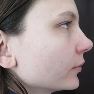 After - <strong>Il mio dermatologo aveva ragione!</strong>