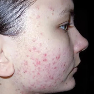 Before - <strong>Il mio dermatologo aveva ragione!</strong>