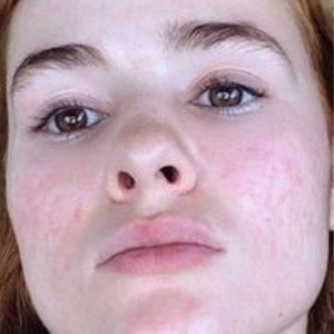 After - <strong>L'acne mi ha rovinato la vita!</strong>