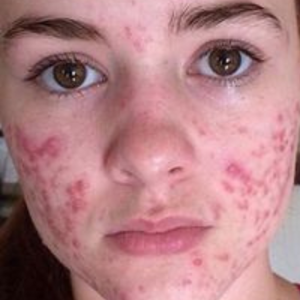 Before - <strong>L'acne mi ha rovinato la vita!</strong>